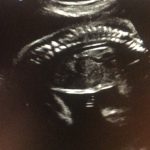 سونوگرافی پیشرفته جنین
